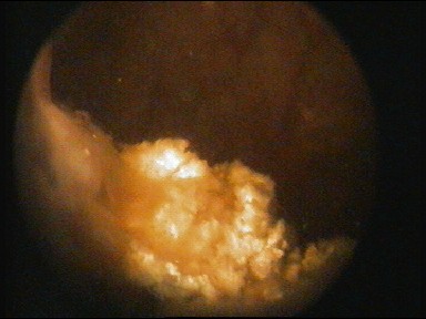 Цистоскопическое обследование пациентки Ф. Цистоскопическая картина инкрустирующего цистита