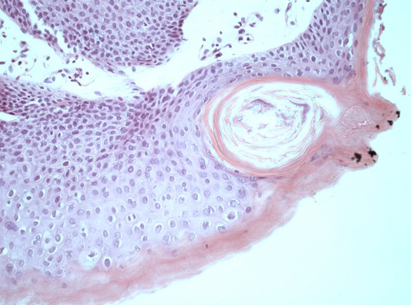 Морфологическая картина лейкоплакии мочевого пузыря