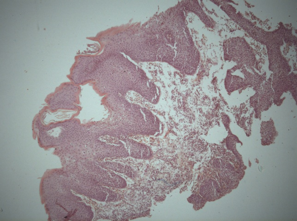 Морфологическая картина лейкоплакии мочевого пузыря