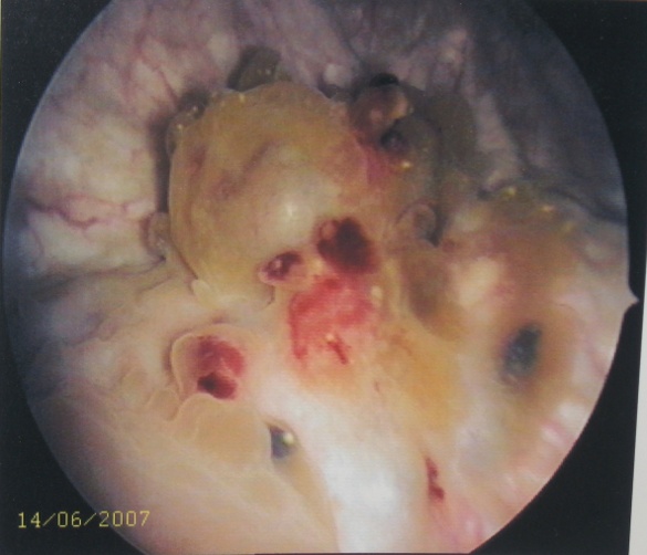 Цистоскопическое обследование пациентки С. Цистоскопическая картина эндометриоидных кист мочевого пузыря