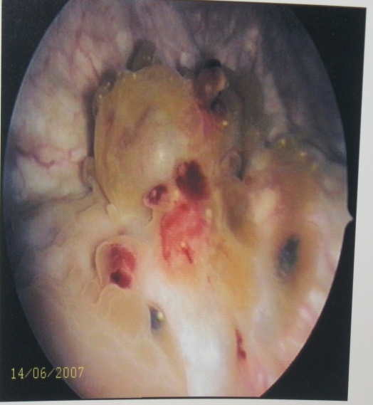 Цистоскопическое обследование пациентки Т. Цистоскопическая картина эндометриоидных кист мочевого пузыря