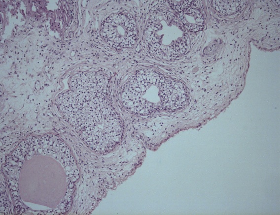 Патоморфологическое исследование пациентки Т. Морфологическая картина эндометриоидной кисты мочевого пузыря. Окраска гематоксилин-эозином, х5