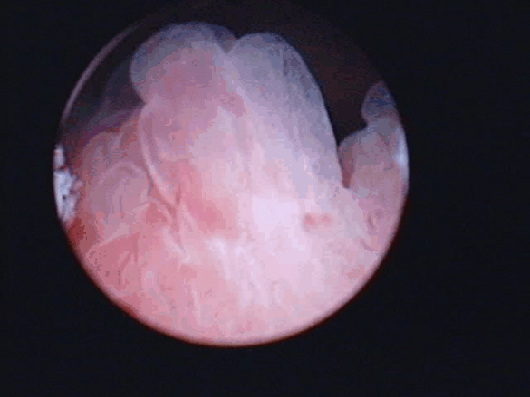 Цистоскопическое обследование пациента П. Цистоскопическая картина  папиллярного грубоворсинчатого образования, вдающегося в полость мочевого пузыря в виде массивных бугристых масс