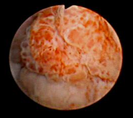 Цистоскопическое обследование пациента О. Цистоскопическая картина  солидного грубоворсинчатого образования мочевого пузыря