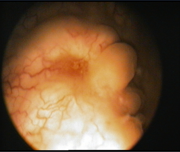 Цистоскопическое обследование пациентки К. Цистоскопическая картина  солидного образования, вдающегося в полость мочевого пузыря