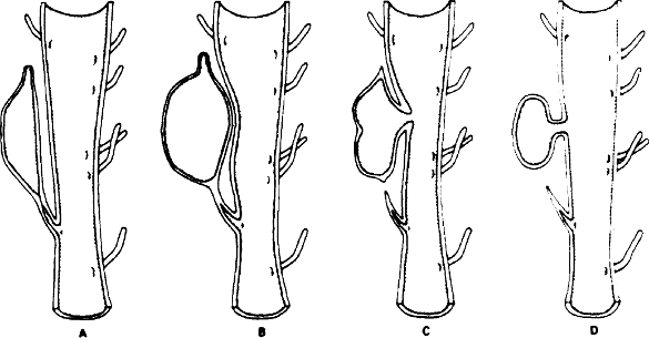 Схема формирования парауретральной кисты и дивертикула уретры