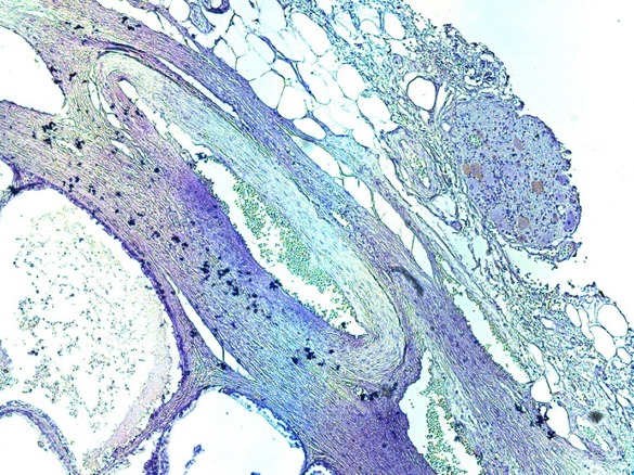 Симпатические нервные волокна в парапростатической ткани окраска ИГХ Tyrosine hydroxylase